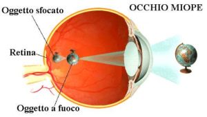 intervento di miopia con laser